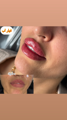 فیلر لب