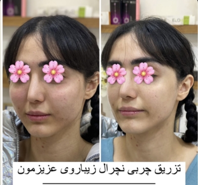 تزریق چربی